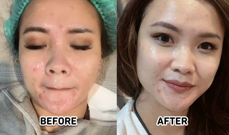 Hasil Facial Korean Glass Skin di Dermis Skin & Slimming Center