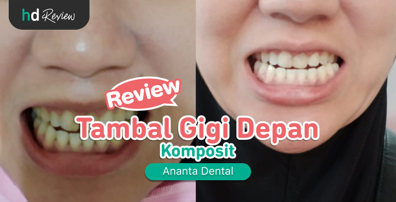 Review Tambal Gigi Depan Komposit di Ananta Dental