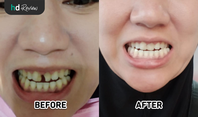 Hasil Tambal Gigi Depan Komposit di Ananta Dental