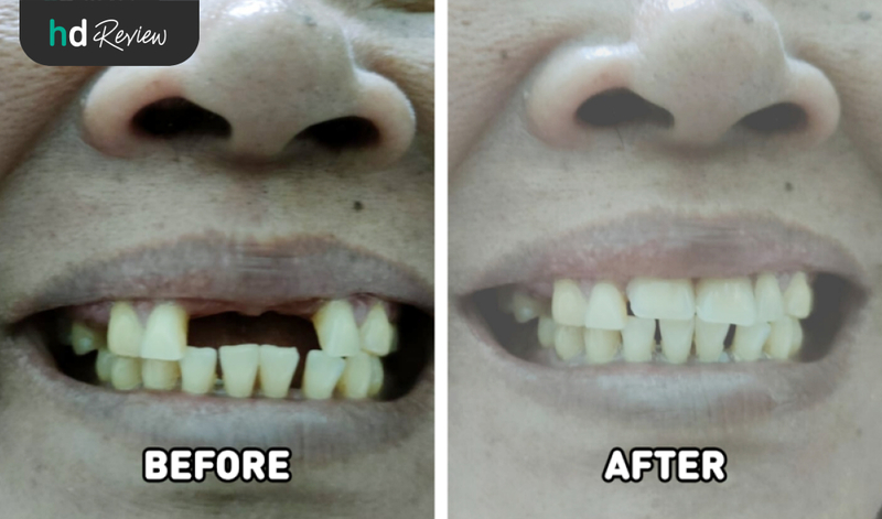 Review Pemasangan Gigi Palsu di Dentalmate Dental Care, gigi palsu depan, gigi lepasan, gigi palsu lepasan