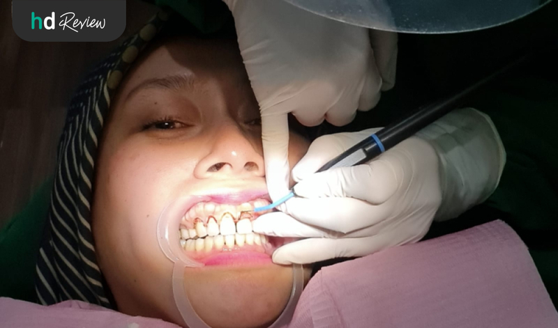 Review Operasi Gusi dengan Gingivektomi (Potong Gusi) di Klinik Tooth Signature, gummy smile, gusi tinggi