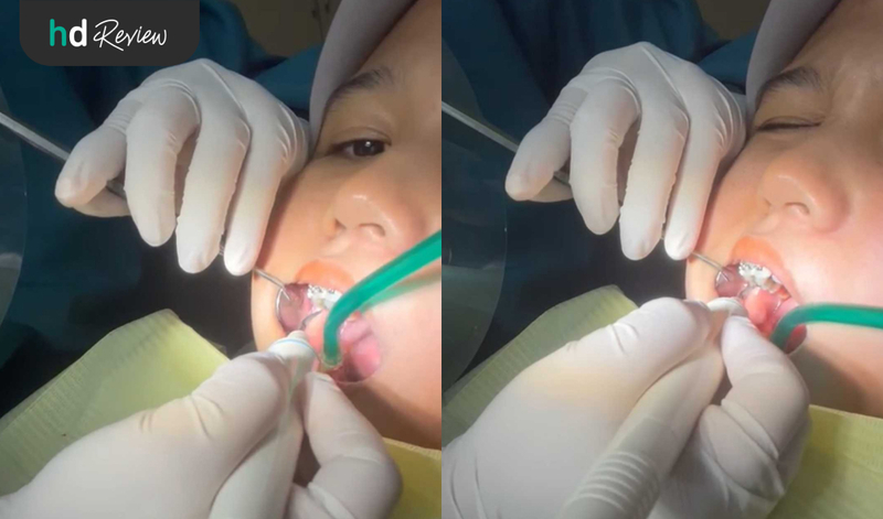 Proses Kontrol Behel di Estetika Dental Clinic
