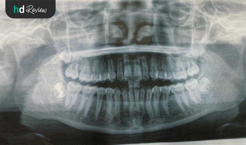 Hasil Rontgen Gigi Panoramic di Adore Dental Clinic