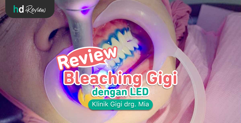 Review Bleaching Gigi di Klinik Gigi drg. Mia, memutihkan gigi, mencerahkan gigi