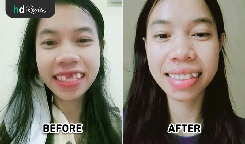 Hasil Gigi Palsu Lepasan Akrilik di Dentalmate Dentalcare