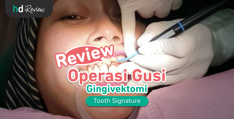 Review Operasi Gusi dengan Gingivektomi (Potong Gusi) di Klinik Tooth Signature, gummy smile, gusi tinggi