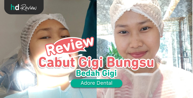 Review Cabut Gigi Bungsu di Adore Dental