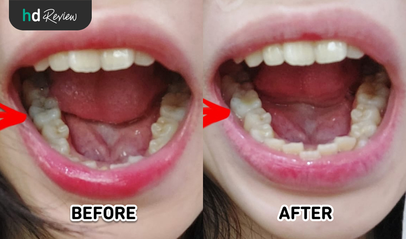 Hasil Tambal Gigi di Teeth Tooth Dental