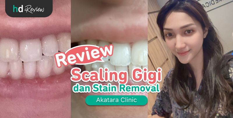 Review Scaling Gigi di Akatara Clinic