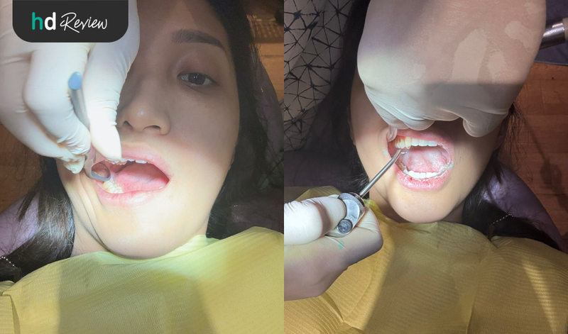 Proses Scaling Gigi di Akatara Clinic