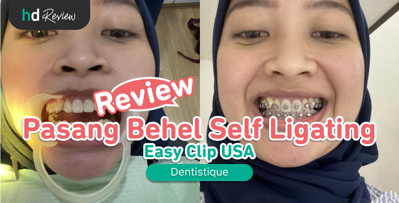 Review Pasang Behel Self Ligating di Dentistique Dental Specialist, pemasangan behel, kawat gigi, behel gigi