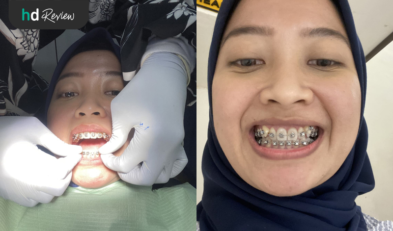 Review Pasang Behel Self Ligating di Dentistique Dental Specialist, pemasangan behel, kawat gigi, behel gigi