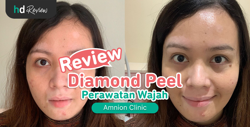 Review Diamond Peel di Amnion Clinic