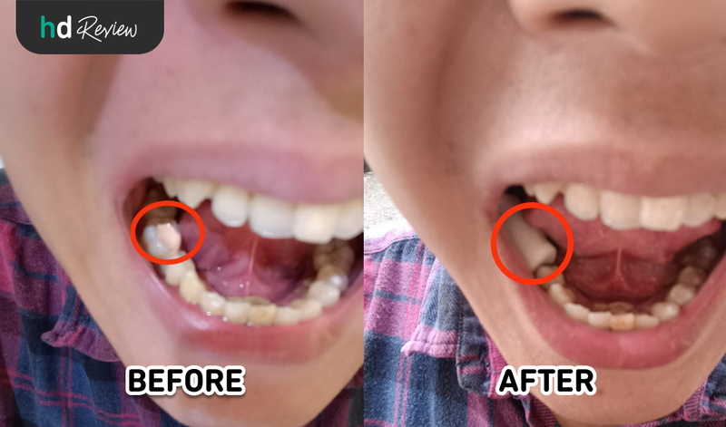 Hasil Perawatan Saluran Akar di JB Dental