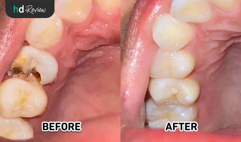Hasil Tambal Gigi di AM Dental Care