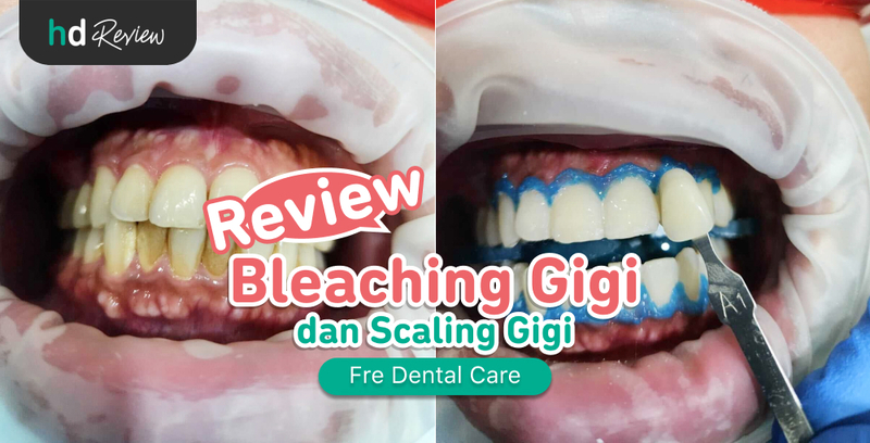 Review Bleaching Gigi di Fre Dental Care