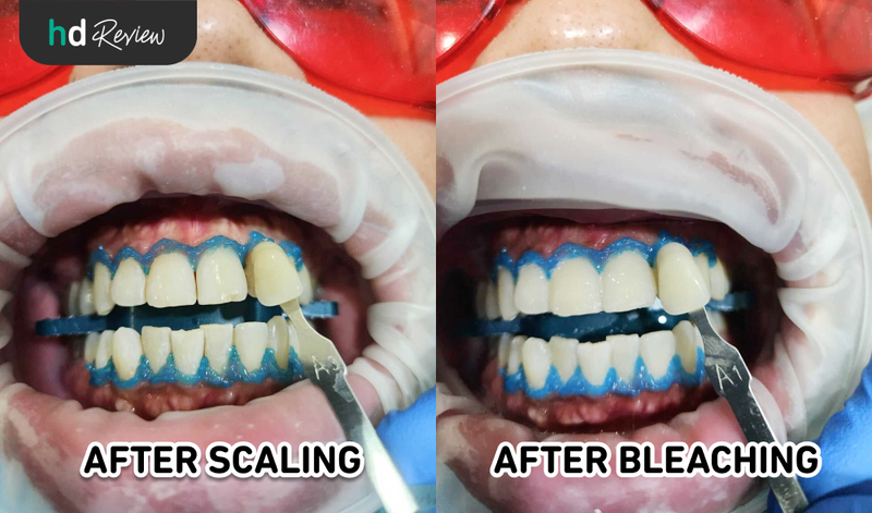 Hasil Bleaching Gigi di Fre Dental Care