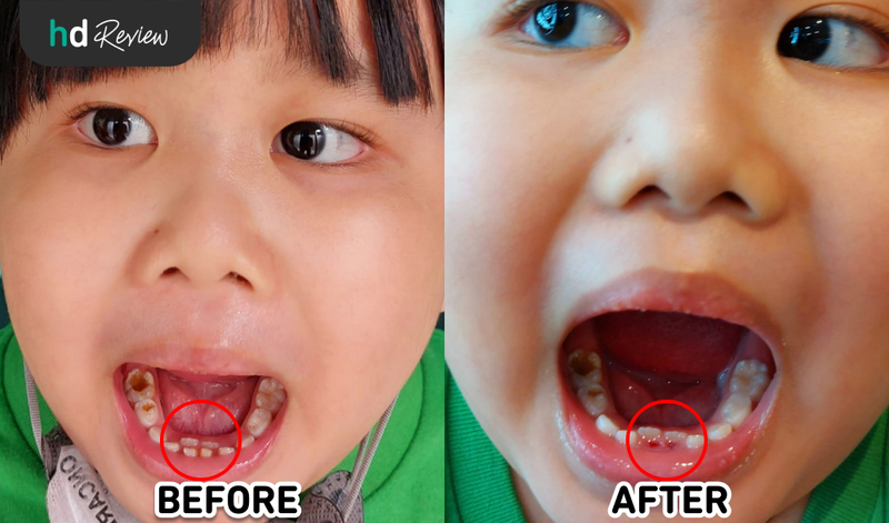 Hasil Cabut Gigi Anak di Prudentalcare drg. Addina Ainul Haq, cabut gigi susu anak