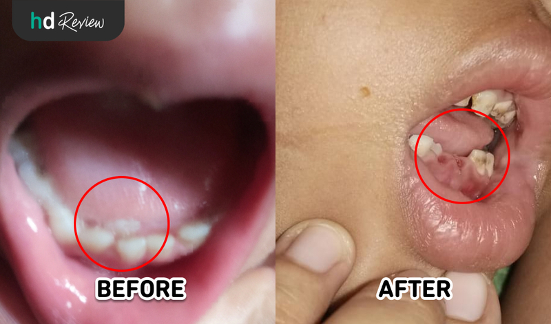 Hasil Cabut Gigi Susu Anak di Ananta Dental