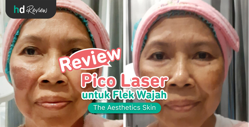 Review Pico Laser di The Aesthetics Skin, flek hitam, flek wajah, flek di wajah, flek kehitaman di wajah, laser wajah