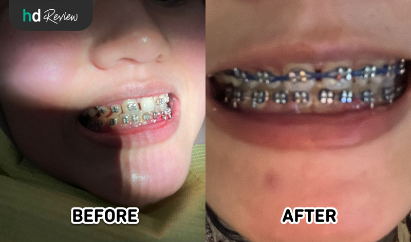 Hasil Kontrol Behel di Dental Home Smile, kontrol kawat gigi