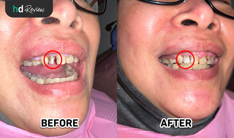 Hasil Tambal Gigi Estetis di Akatara Clinic, tambal gigi depan