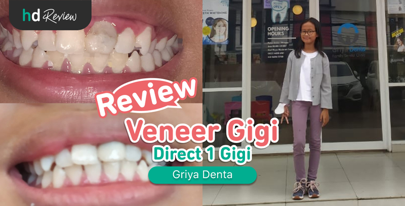 Review Veneer Direct 1 Gigi di Griya Denta, direct veneer, veneer gigi