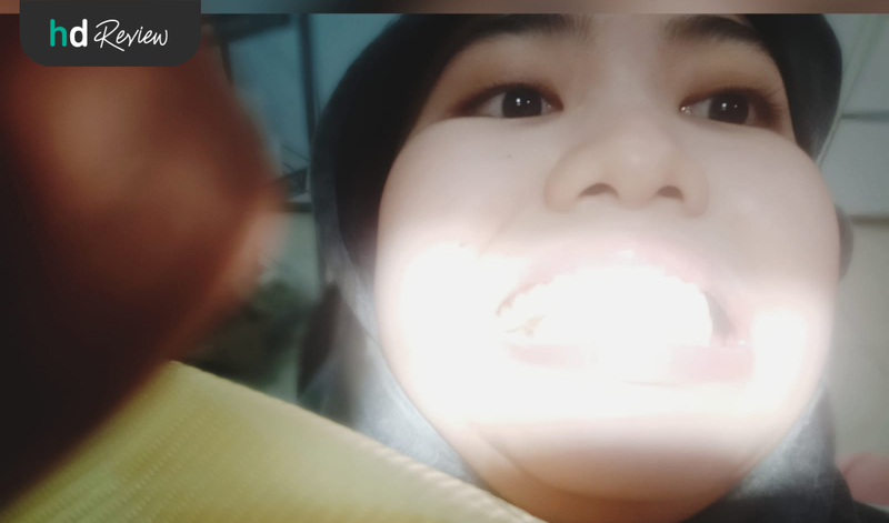 Proses Tambal Gigi di Pixel Dental, gigi berlubang, tambal gigi berlubang