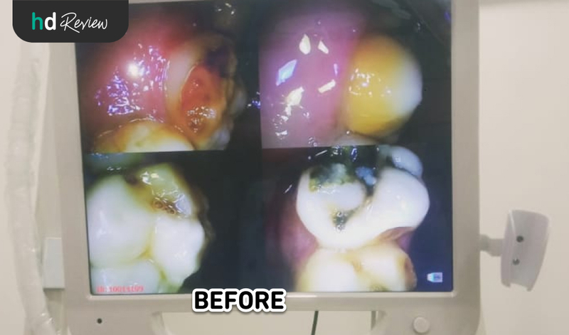 Hasil Tambal Gigi di Pixel Dental, gigi berlubang, tambal gigi berlubang