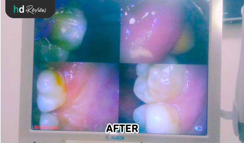 Hasil Tambal Gigi di Pixel Dental, gigi berlubang, tambal gigi berlubang