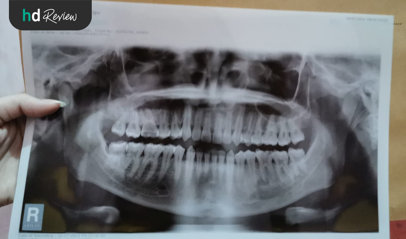 Hasil Rontgen Panoramic di Klinik 2000 Tiga, rontgen gigi