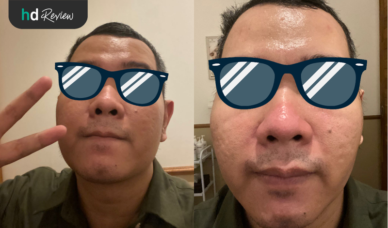 Hasil Oxy Facial di Oriskin Bintaro, facial oxy