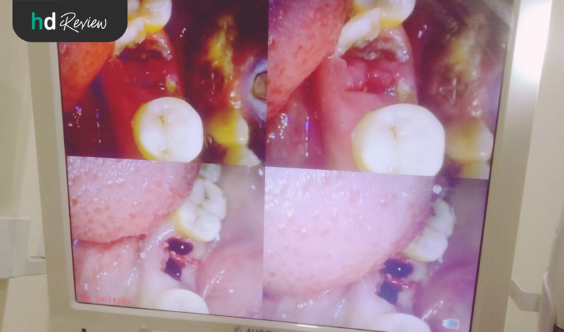 Hasil Cabut Gigi Sisa Akar di Pixel Dental, cabut sisa akar gigi