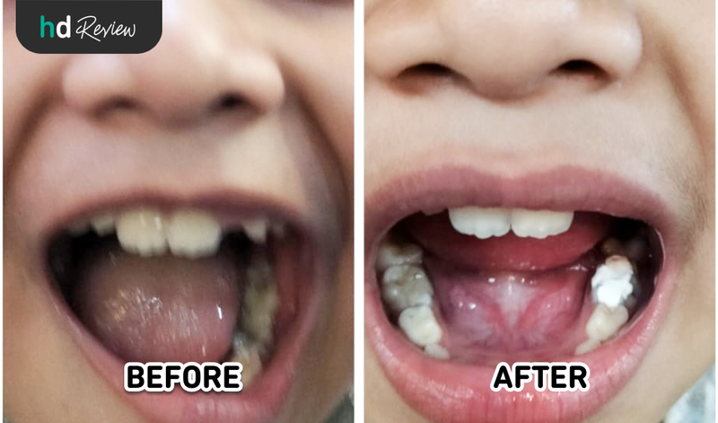 Hasil Tambal Gigi Susu di Canina Dental Care, tambal gigi anak, tambal gigi susu anak