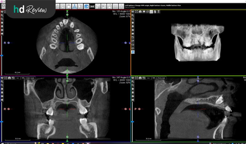 Review Rontgen Panoramic CBCT di BSD Dental Centre, Lihat Gambar Gigi Lebih Jelas, rontgen gigi
