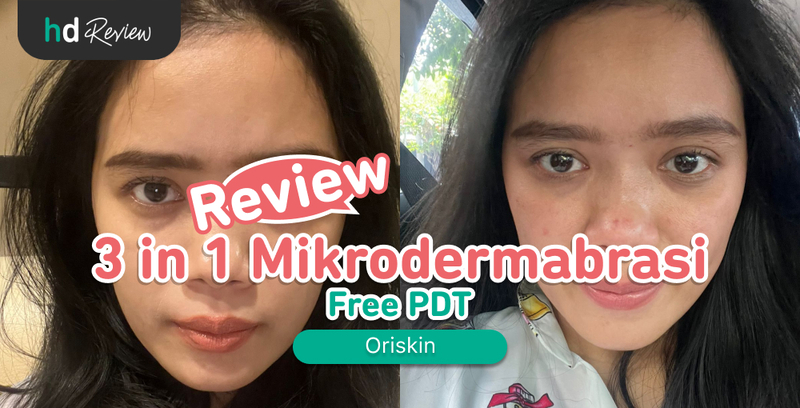 Review Mikrodermabrasi PDT di Oriskin, facial mikrodermabrasi