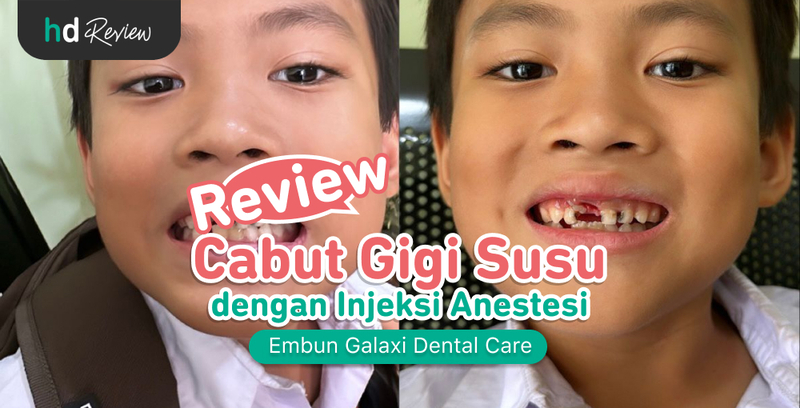Review Cabut Gigi Susu di Embun Galaxi Dental Care, gigi susu, gigi permanen, perawatan gigi anak