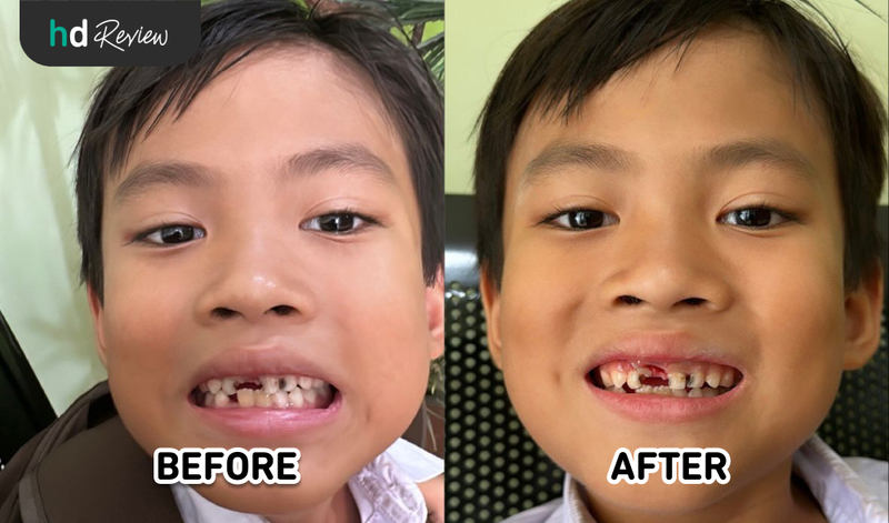 Review Cabut Gigi Susu di Embun Galaxi Dental Care, gigi susu, gigi permanen, perawatan gigi anak