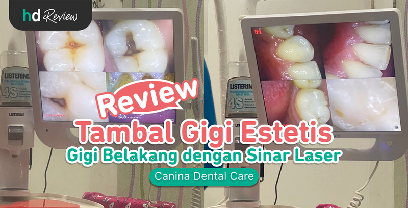Review Tambal Gigi Belakang Estetis di Canina Dental Care, tambal gigi, penambalan gigi, gigi berlubang, scaling gigi, pembersihan karang gigi