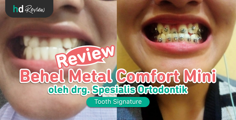 Review Pasang Behel Metal Comfort Mini di Tooth Signature, pemasangan behel metal, behel metal, jenis behel