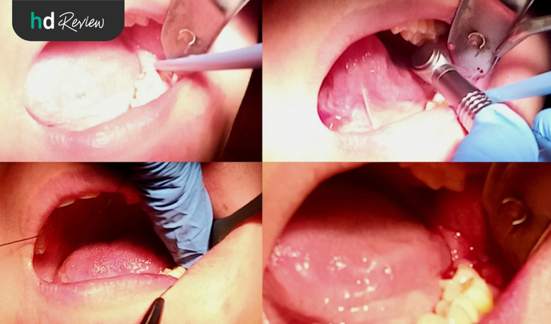 Review Cabut Gigi Bungsu di Akatara Clinic, odontektomi, perawatan gigi bungsu