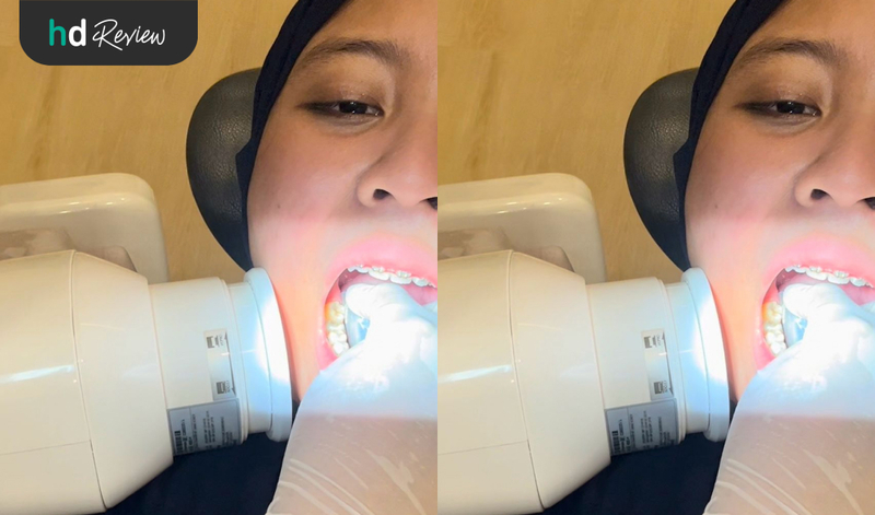 Review Rontgen Periapical di Dontics Dental, rontgen gigi, periapical x-ray