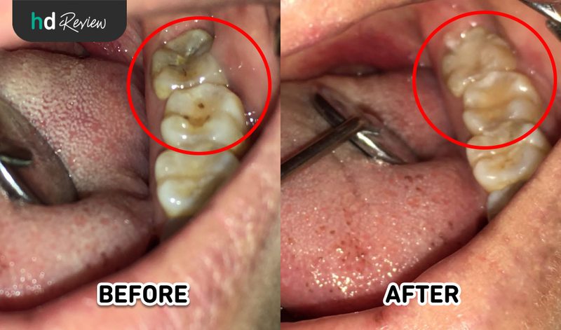 review tambal gigi di D'Dental Care, penambalan gigi