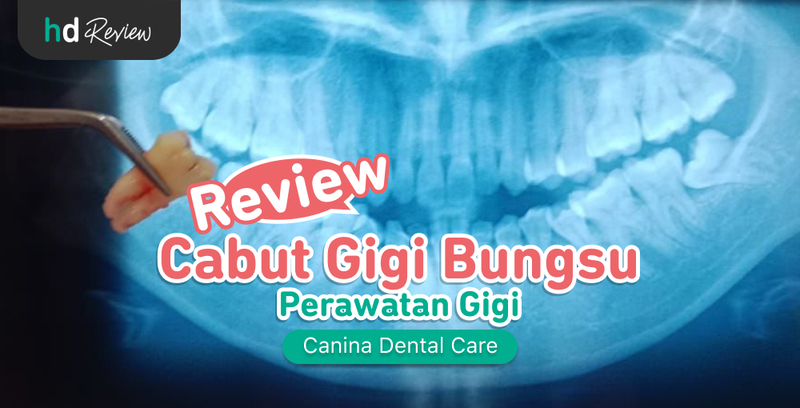 Review Cabut Gigi Bungsu di Canina Dental Care, odontektomi