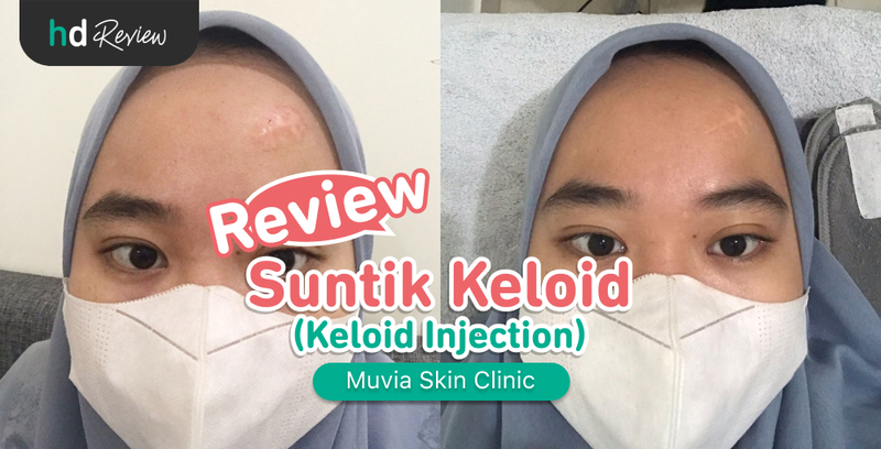 Review Suntik Keloid di Muvia Skin Clinic, injeksi keloid, keloid removal, menyamarkan keloid, menghilangkan keloid, keloid injection