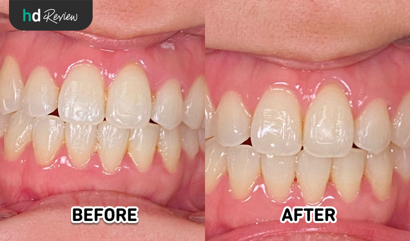Review Deep Scaling di Drg. Leony Ricci, scaling gigi, karang gigi, plak, pembersihan karang gigi