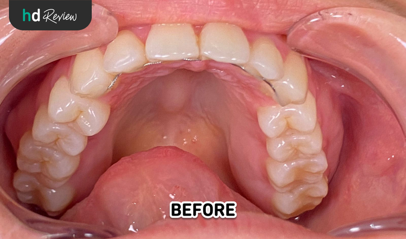 Review Deep Scaling di Drg. Leony Ricci, scaling gigi, karang gigi, plak, pembersihan karang gigi