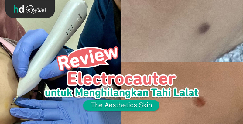 Review Electrocauter di The Aesthetics Skin untuk Hilangkan Tahi Lalat Membesar, cauter, electrosurgery, skin tag, kutil