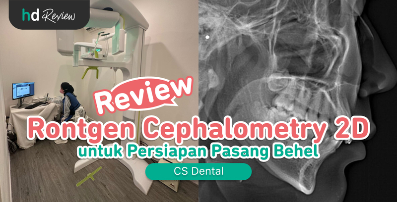 Review Rontgen Cephalometri 2D di CS Dental untuk Persiapan Pasang Behel, sefalometri, cephalometry, rontgen gigi