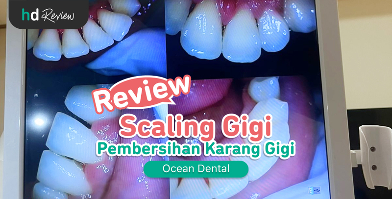 Review Scaling Gigi di Ocean Dental, Bersihkan Karang Gigi yang Bikin Ngilu, plak gigi